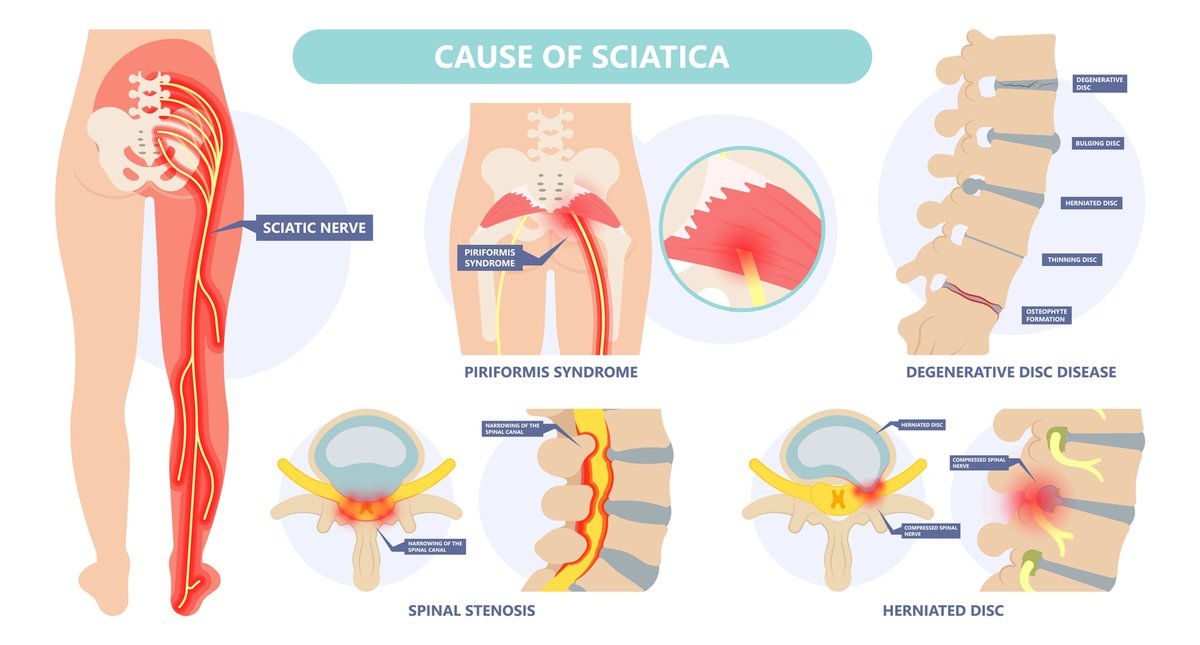 Can Physical Therapy help sciatica?